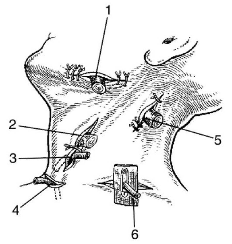 Вскрытие флегмоны шеи. Дренирование абсцессов и флегмон шеи. Дренирование флегмон шеи. Разрезы при флегмонах шеи.