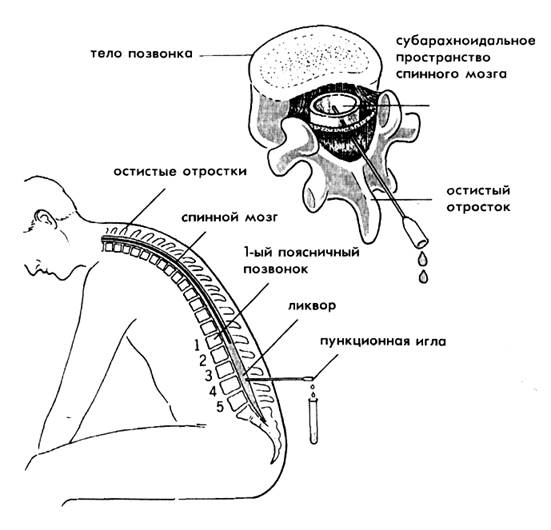 Пункция мозга последствия. Субарахноидальное пространство спинномозговая жидкость. Анатомия спинного мозга люмбальная пункция. Пункция для исследования спинномозговой жидкости. Люмбальная пункция схема.
