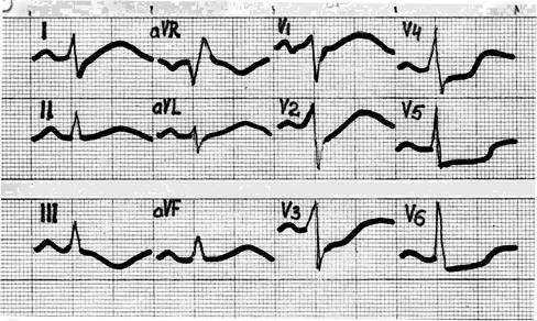 Поворот сердца правым желудочком вперед что это. ЭКГ признаки поворота сердца. Поворот сердца верхушкой вперед на ЭКГ. Поворот сердца правым желудочком ЭКГ. Поворот сердца верхушкой кзади на ЭКГ.