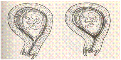 Реферат: Внематочная беременность, начавшийся самопроизвольный аборт