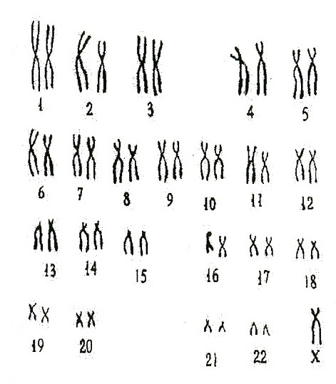Хромосом группы d. Кариотип человека классификация хромосом человека. Цитогенетический метод классификация хромосом человека. Кариотип классификация хромосом. Парижская классификация хромосом.