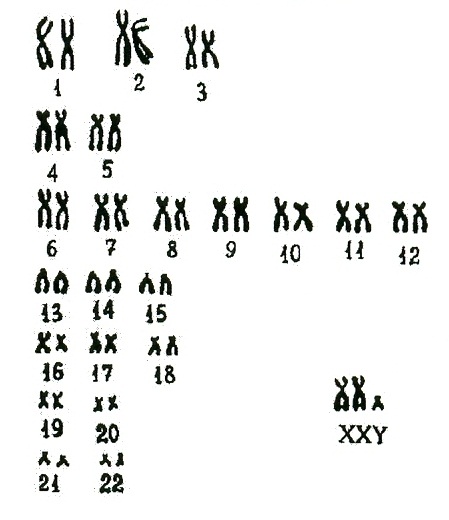 Хромосом группы d. Кариотип Денверская классификация. Кариотип человека Денверская классификация. Денверская классификация хромосом человека таблица. Кариотип классификация хромосом.