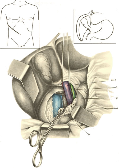 Операция 5 14. Портокавальный анастомоз операция. Атлас операций на брюшной полости. Операции на желчных протоках. Анастомоз желчного протока.