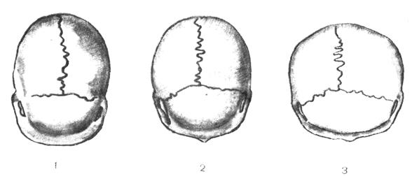 Варианты формы черепа. Яйцевидная форма черепа. Скошенная форма черепа человека.