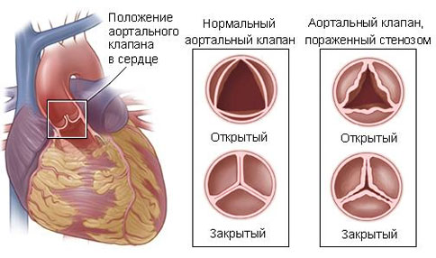Реферат: Недостаточность клапанов и сужение отверстия легочной артерии