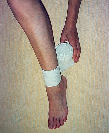 Эластичные бинты после операции эндопротезирования. Забинтовать ногу эластичным бинтом. Гемартроз голеностопного сустава.