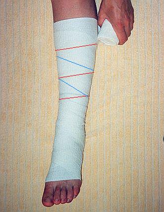 Бинтование ноги после операции. Эластичный бинт на ногу. Перевязка ноги эластичным бинтом. Бинтование стопы эластичным бинтом.