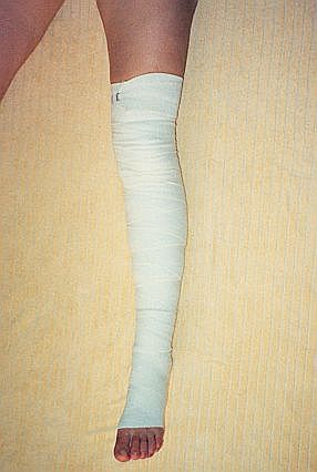 Эластичные бинты после операции эндопротезирования. Забинтовать ногу эластичным бинтом. Гипсовая повязка на стопу. Бинты послеоперационные на ноги.