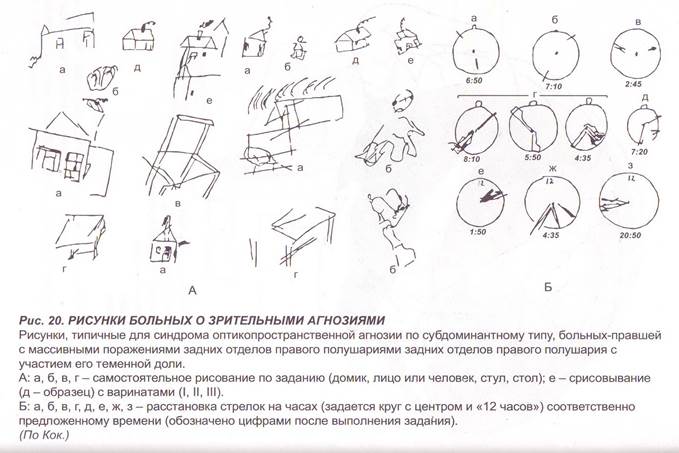 Вид агнозии характеризующийся нарушением узнавания предметов или их изображений