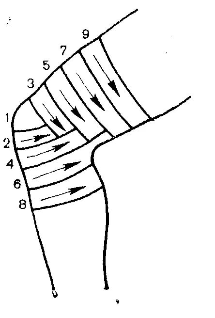 Забинтовать колено эластичным. Черепашья сходящаяся перевязка на колено. Черепашья сходящаяся на коленный сустав повязка. Черепашья сходящаяся повязка на коленный алгоритм. Черепашья бинтовая повязка.
