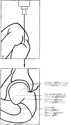Изображение - Рентгенография тазобедренных суставов по лаунштейну image455