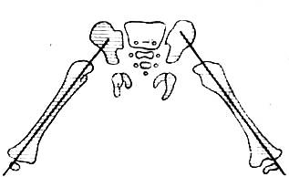 Изображение - Рентгенография тазобедренных суставов по лаунштейну image495