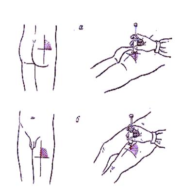 Схема внутримышечной инъекции