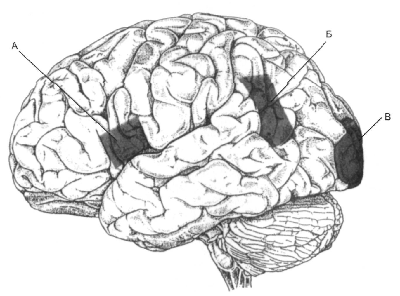 Очаги в коре головного мозга. Височный отдел коры головного мозга сенсорная афазия. Аграфия локализация поражения. Поражение головного мозга. Повреждение коры головного мозга.