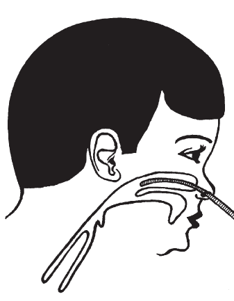 Через носовой катетер. Носовой катетер для оксигенотерапии. Подача кислорода через носовой катетер. Подача кислорода через носовой катетер рисунок. Подача кислорода через носовую канюлю.