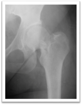 Остеосинтез тазобедренного сустава рентген. Перелом шейки левой бедренной кости. Сросшийся перелом шейки бедренной кости. Остеосинтез шейки бедра канюлированными винтами. Шейка бедра заживает