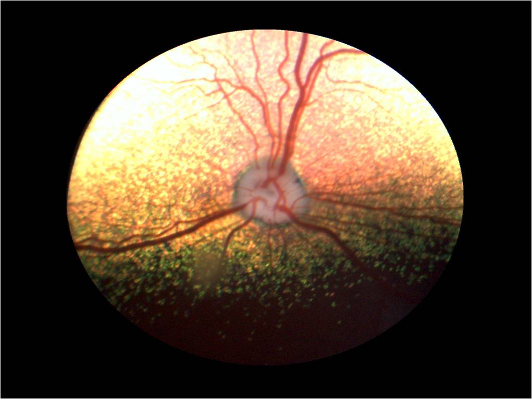 Периневральное пространство зрительного нерва. Офтальмоскопия глазного дна норма. Топография глазного дна. Зрительный нерв глазное дно норма. Неврит зрительного нерва.
