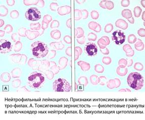 Лейкоцитоз нейтрофилез. Нейтрофильный лейкоцитоз без ядерного сдвига. Нейтрофильный лейкоцитоз картина крови. Лейкоцитоз с нейтрофильным сдвигом.