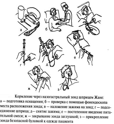 Назогастральный зонд алгоритм кормления. Питание пациента через назогастральный зонд алгоритм. Кормление через назогастральный зонд. Кормление через назогастральный зонд алгоритм. Кормить пациента через назогастральный зонд алгоритм.