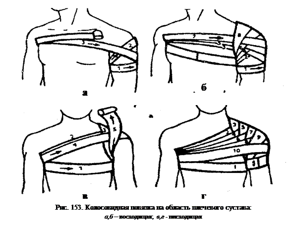 Плечевая повязка алгоритм. Алгоритм наложения колосовидной повязки. Колосовидная повязка на плечевой сустав алгоритм. Наложение колосовидной повязки на плечевой сустав. Техника наложения колосовидной повязки на плечо.