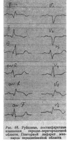 Изменение миокарда перегородочной области. ЭКГ инфаркт миокарда, рубцовые изменения. Рубцовые изменения на ЭКГ после инфаркта. Постинфарктный рубец на ЭКГ. Рубец инфаркт миокарда ЭКГ.
