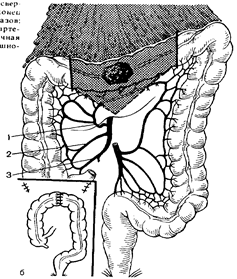 Поперечно ободочная кишка. Поперечно ободочный отдел толстой кишки. Что такое стенозирующая опухоль поперечно ободочной кишки. Полип поперечного отдела ободочной кишки. Поперечная ободочная кишка анастомоз.