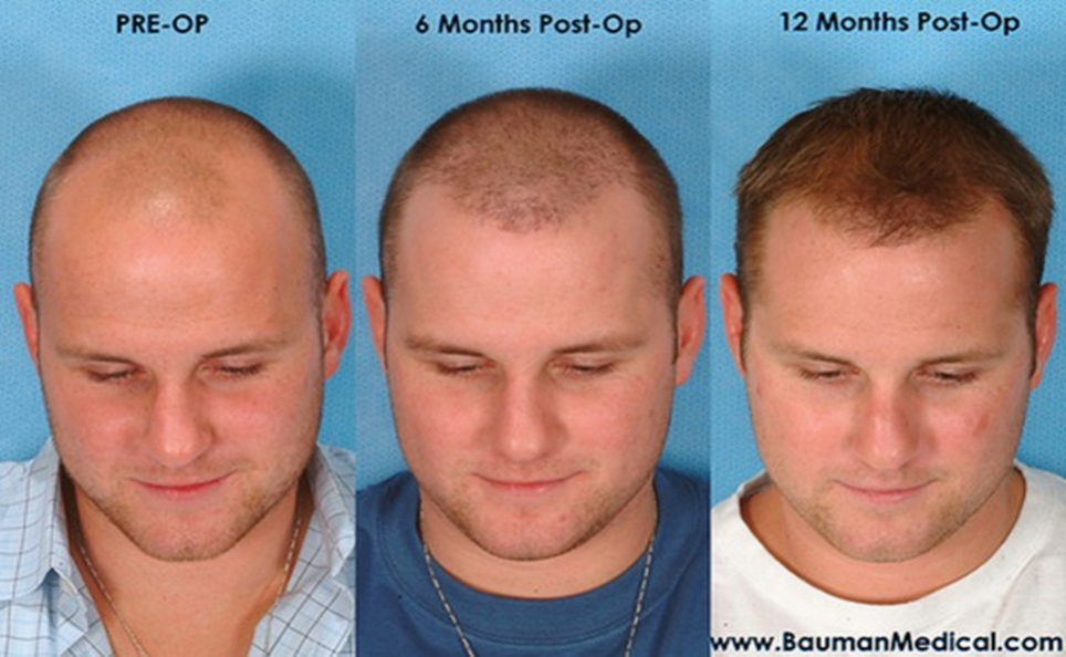 У мужчины 5 см. Прически при облысении. До и после пересадки волос мужчинам. Прически после пересадки волос.