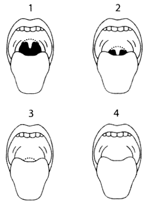 Во сколько открывают рот. Оценка дыхательных путей Маллампати. Последовательность открывания рта.