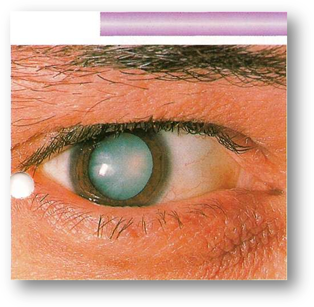 Факолитическая катаракта. Биомикроскопия хрусталика катаракта. Сенильная диабетическая катаракта. 1 признаки катаракты