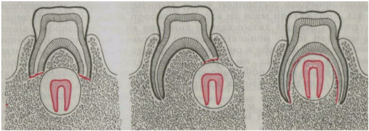 Рассосался корень зуба. Резорбция корня молочного зуба. Периодонтит молочных зубов на рентгене.