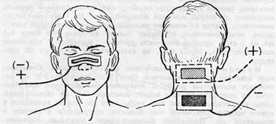 Брома на воротниковую зону. Гальванизация и лекарственный электрофорез. Электроды для гальванизации. Электрофорез по Щербаку методика с бромом. Эндоназальный электрофорез методика.