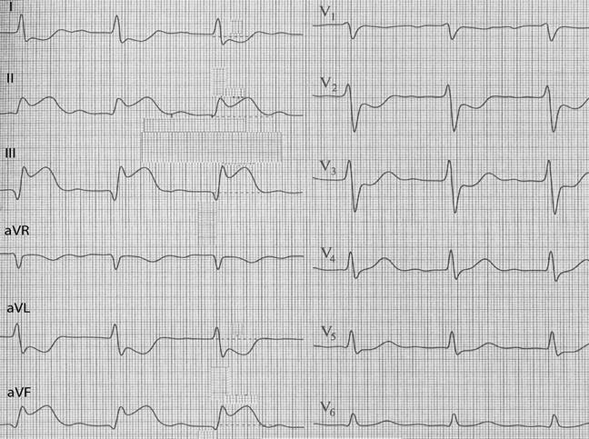 Очаговые изменения желудочка. Инфаркт миокарда нижней стенки лж. Заднедиафрагмальный инфаркт миокарда ЭКГ. Заднебазальный инфаркт миокарда ЭКГ. V4-v6 ЭКГ стенка.