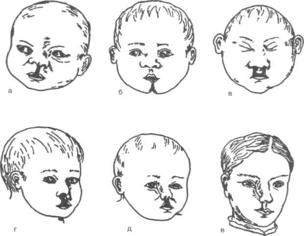 Развитие лицевой области. Врожденные аномалии ЧЛО. Врожденные пороки развития ЧЛО. Срединная расщелина нижней челюсти. Врождённые расщелины ЧЛО.