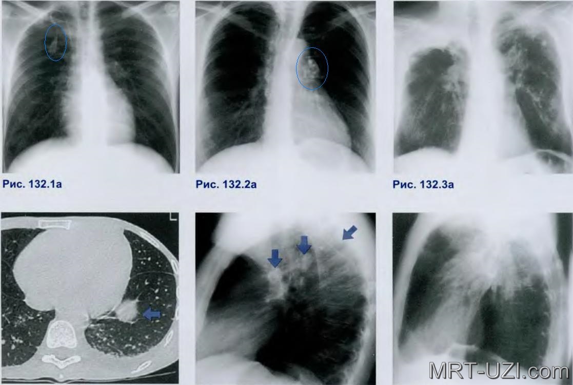 После флюорография можно можно кт делать. Туберкулез рентген снимки. Очаговый туберкулез рентген кт. Пневмония и туберкулёз на снимке рентгена. Туберкулез легкого рентгенограмма.