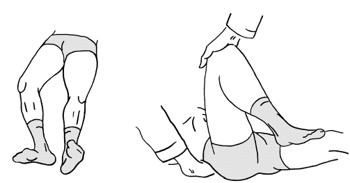 Сгибательная контрактура сустава