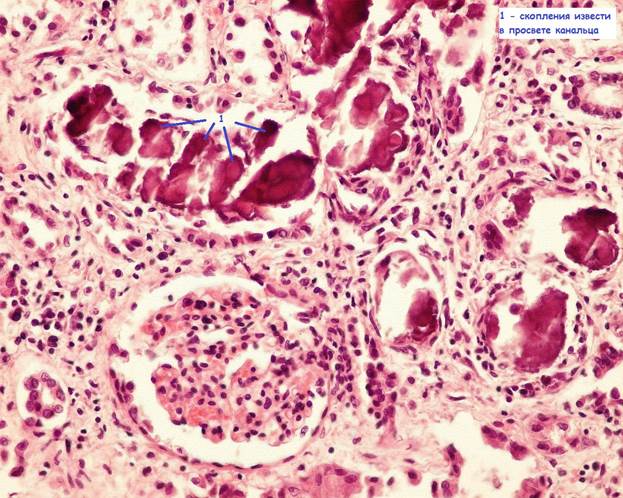 Зернистая дистрофия микроскопическая картина
