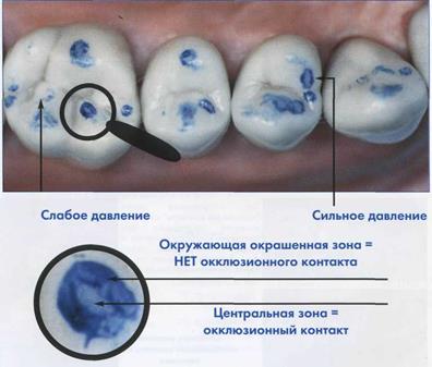 Избирательное сошлифовывание зубов презентация