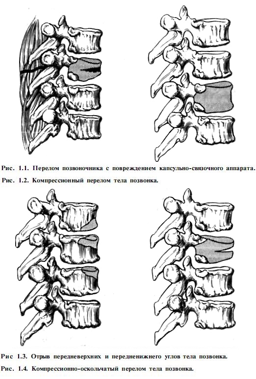 Клиническая картина травм позвоночника