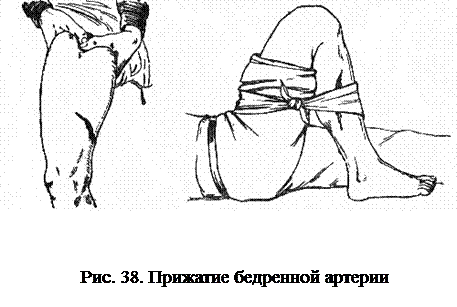 Бедренное кровотечения. Перевязка подколенной артерии.