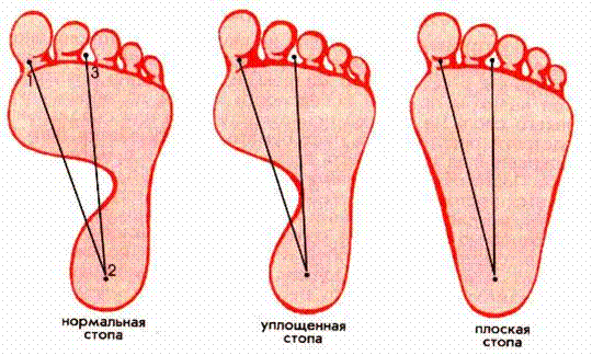 Нормальная стопа. Оценка плантограммы плоскостопие поперечное. Нормальная форма стопы. Уплощенная стопа и плоская. Плантограмма нормальной стопы.