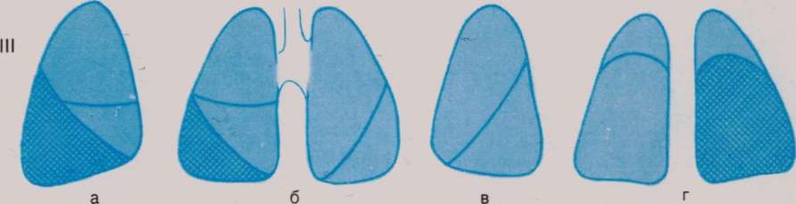 Пневмония верхней доли легкого. Долевая пневмония. Долевая и сегментарная пневмония отличия. Схема долевого строения легких в прямой и боковой проекциях.