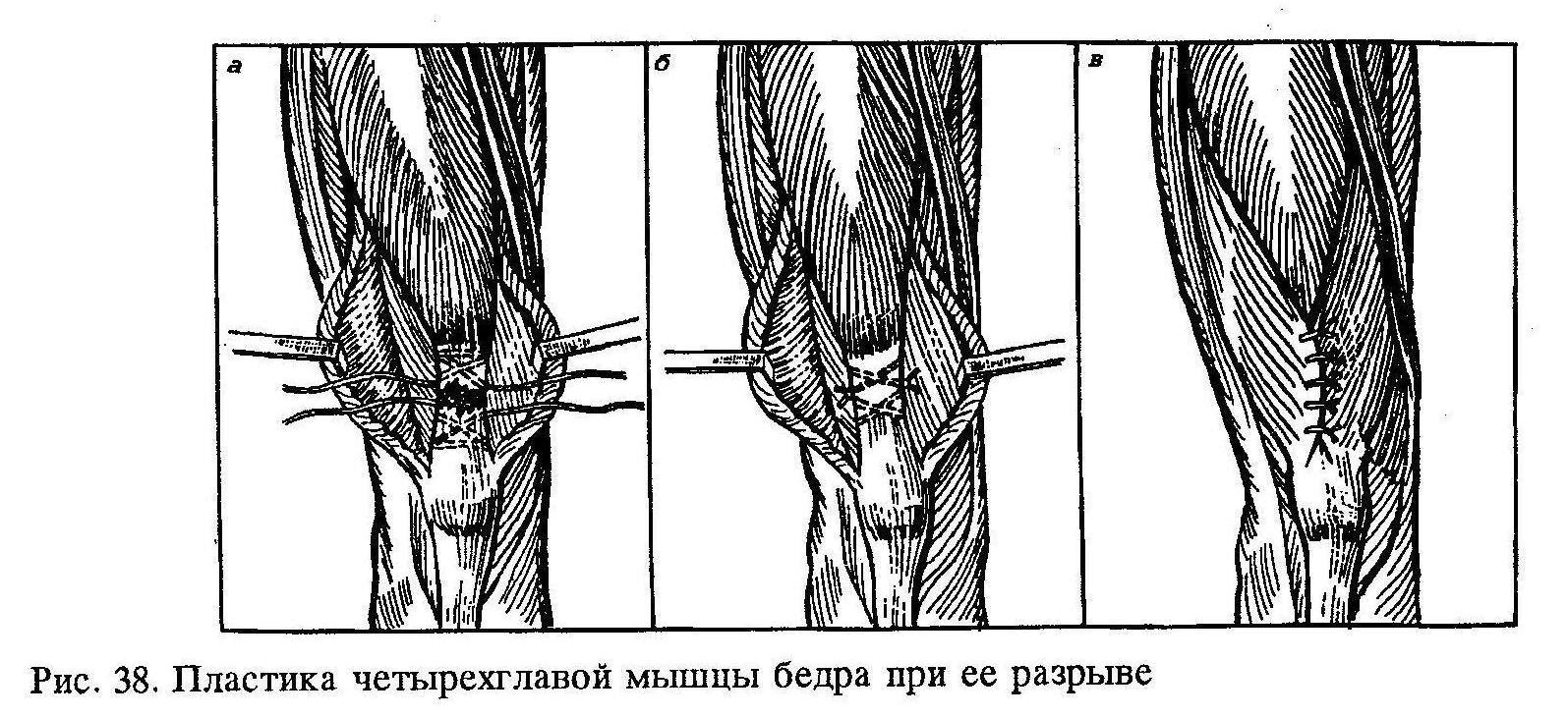 Бедренный разрыв. Шов сухожилия четырехглавой мышцы бедра. Разрыв четырехглавой мышцы бедра операция. Операция четырехглавой мышцы колена. Травма сухожилия четырехглавой мышцы.