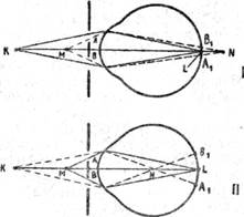 Схема преломления лучей хрусталиком глаза при рассматривании близко и далеко