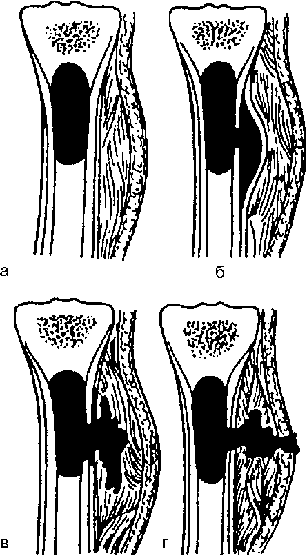 Изображение - Гнойные заболевания костей и суставов image110