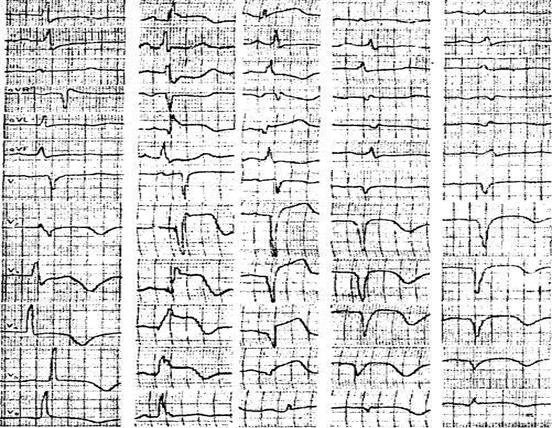 Экг в динамике что это. Внутреннее отклонение на ЭКГ. Увеличение времени внутреннего отклонения на ЭКГ. Время внутреннего отклонения на ЭКГ. Динамическая электрокардиография это.