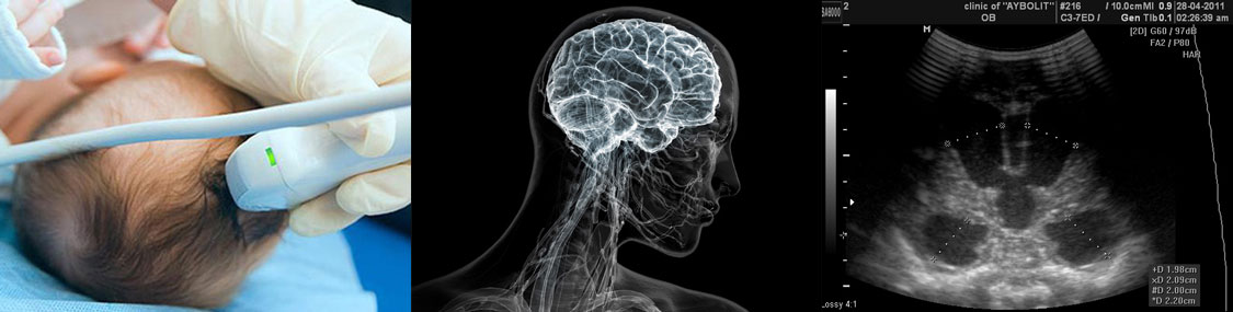 Что лучше мрт или узи головного мозга. УЗИ головного мозга нейросонография. Ультразвуковая допплерография сосудов головы. Нейросонография новорожденных. Транскраниальная допплерография.