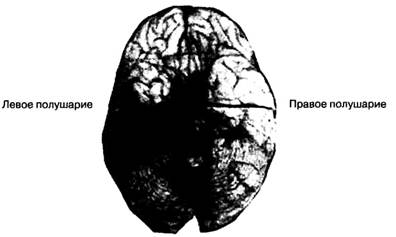 Левое полушарие мозга инсульт