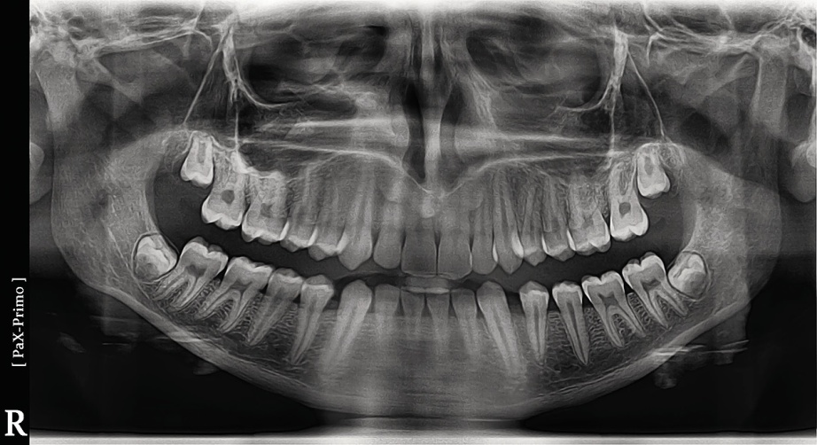 Зубов ташкент. Ортопантомограмма (ОПТГ).
