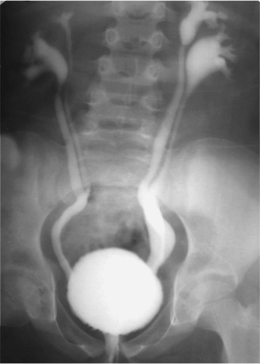Рентген мочеточника. Пузырно мочеточниковый рефлюкс цистография. Пузырно-мочеточниковый рефлюкс экскреторная урография. Микционная цистоуретрография рефлюкс.