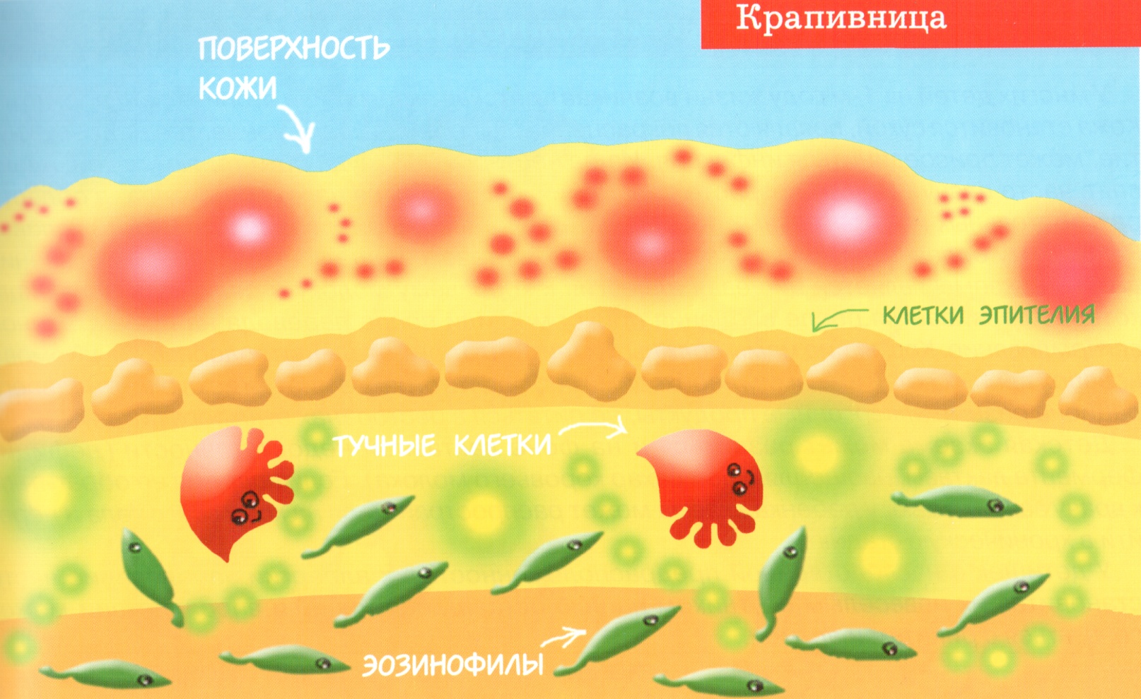 Крапивница классификация